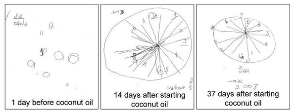 Alzheimer's clock test results before and after coconut oil