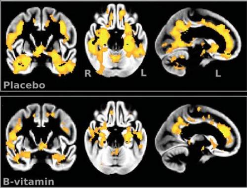 brain scans comparing atrophy of those who took b vitamins vs a placebo